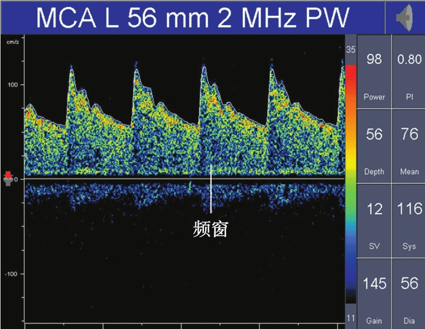 TCD多普勒正常血流頻譜可見頻窗